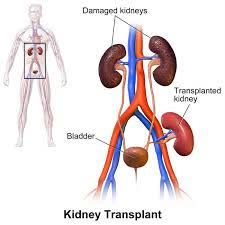transplant